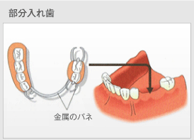 部分入れ歯の概要図