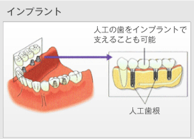 インプラントの概要図