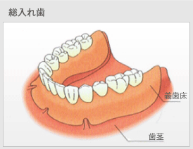 総入れ歯の概要図