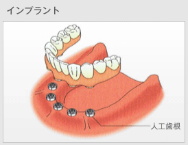 インプラントの概要図