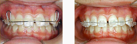 矯正治療の流れ 矯正装置の装着