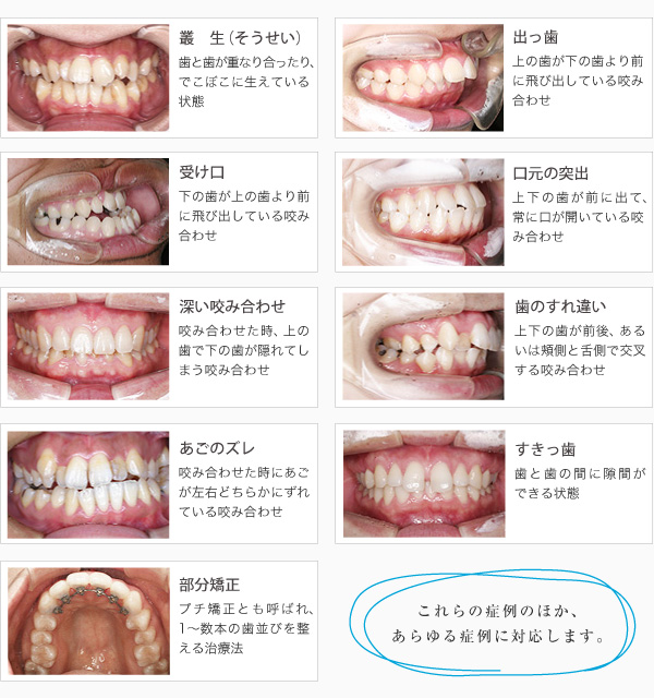 叢生｜出っ歯｜受け口｜口元の突出｜深い咬み合わせ｜歯のすれ違い｜あごのズレ｜すきっ歯｜部分矯正（プチ矯正）などを裏側矯正で治療できます