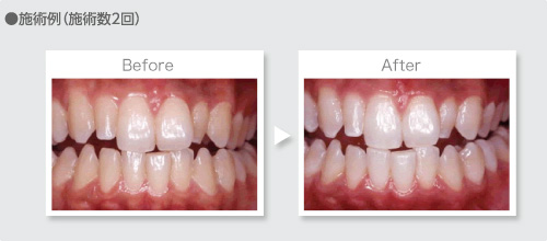 施術例（施術数2回）
