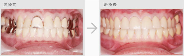 審美歯科治療法 治療前・治療後