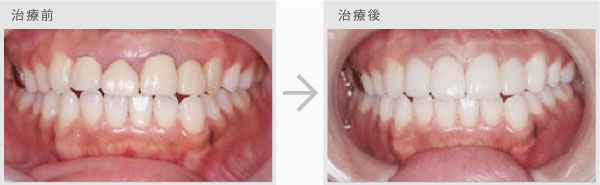 審美歯科治療法 治療前・治療後