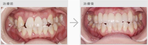 審美歯科治療法 治療前・治療後