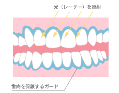 オフィスホワイトニング図